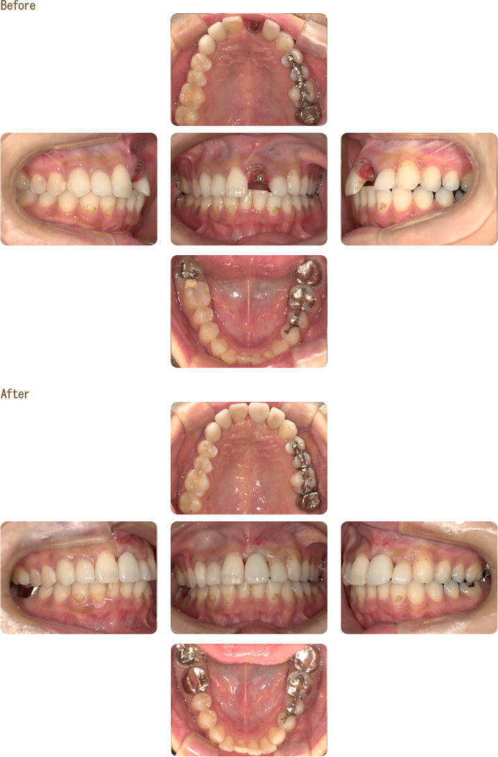 前歯部をセラミックに変えた症例の写真