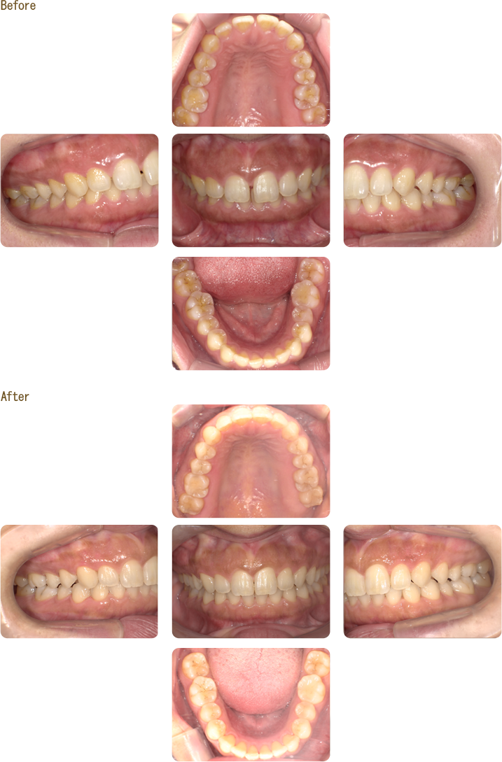 マウスピース型矯正装置(インビザライン)の症例写真