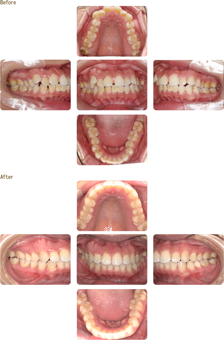 マウスピース型矯正装置（インビザライン）+親知らず抜歯の症例写真