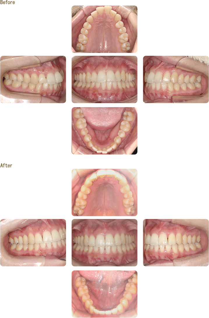 マウスピース型矯正装置（インビザライン）の症例写真