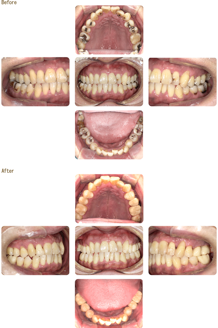 短期集中治療、セラミック治療、自費精密根管治療症例の写真
