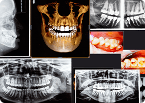 口腔内写真・レントゲン写真で治療前と治療後を比較します 