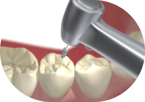 できるだけ歯を残すむし歯治療