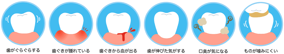 こんな症状があれば歯周病を疑ってください