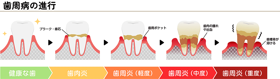 歯周病の進行