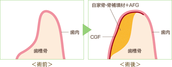CGF凝集性長因子