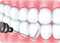 歯石の除去
