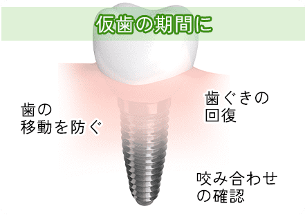 プロビジョナルレストレーション